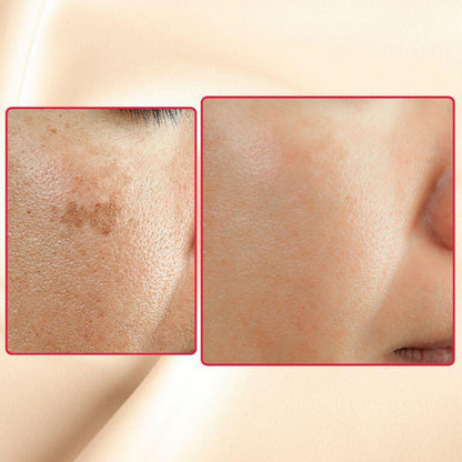 Gymsegbë - The Eraser Spot Cream | Dark Spot Remover