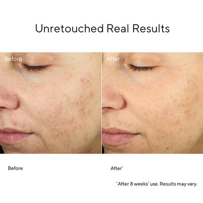 Murad Blemish Control InvisiScar Resurfacing Treatment